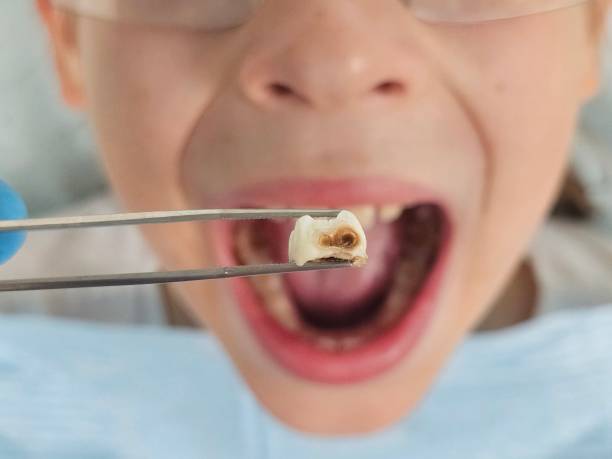 Best Emergency Dental Care for Broken or Chipped Teeth in Dunean, SC